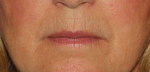Filler & Botox to lip lines Before